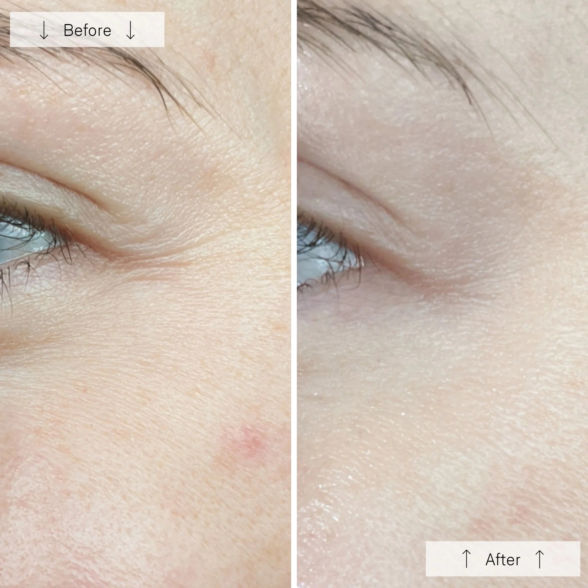 Before and after comparison of skin texture around an eye.