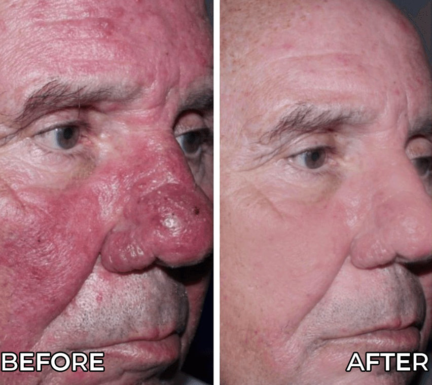 Before and after comparison of a man's face with visible skin texture and redness.