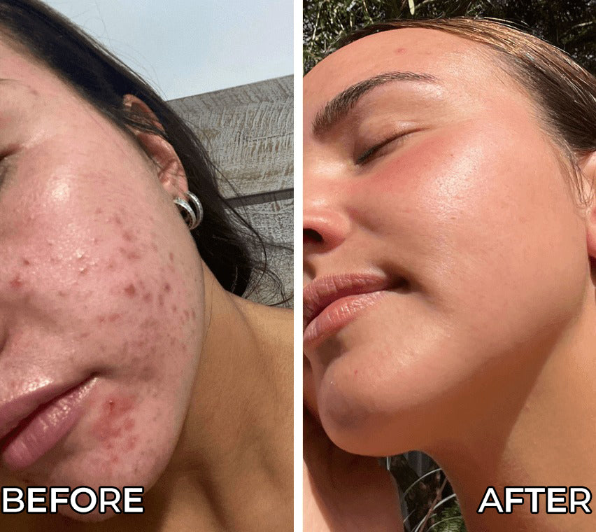Before and after comparison of a person's face with visible acne on the left and clear skin on the right.