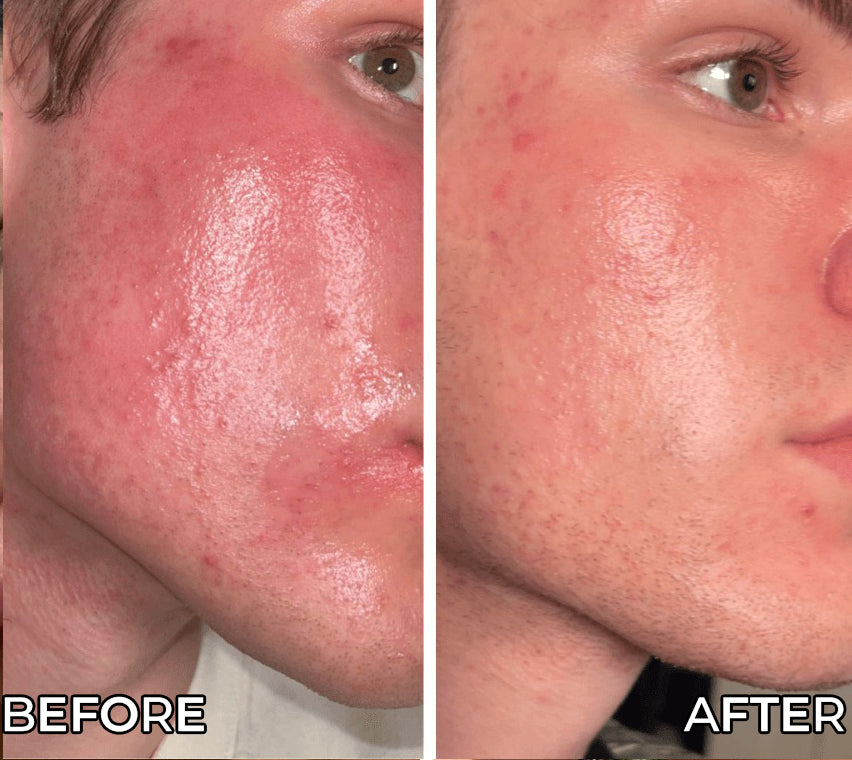 Before and after comparison of a person's face with visible skin condition changes.