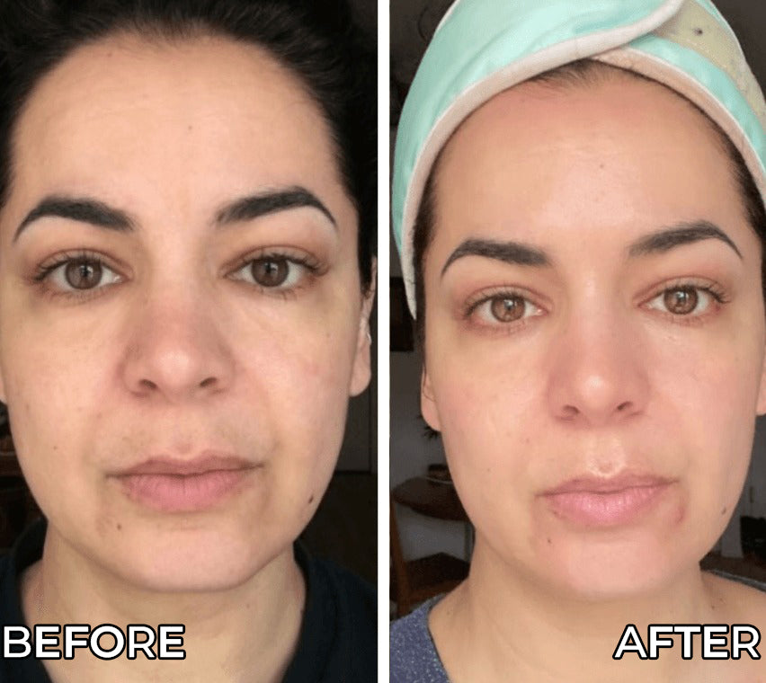 Before and after comparison of a woman's face with 'Before' on the left and 'After' on the right.