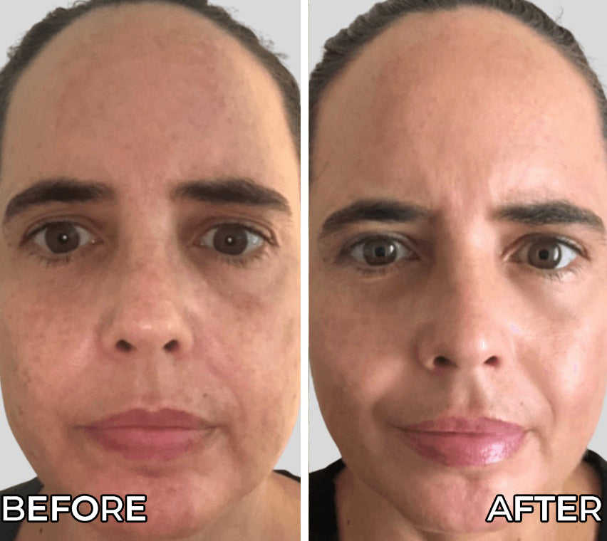 Before and after comparison of a person's face with 'Before' on the left and 'After' on the right.