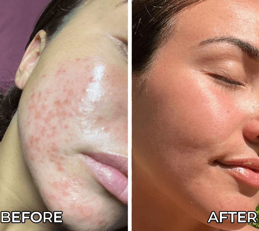 Before and after comparison of a person's face with visible skin conditions.