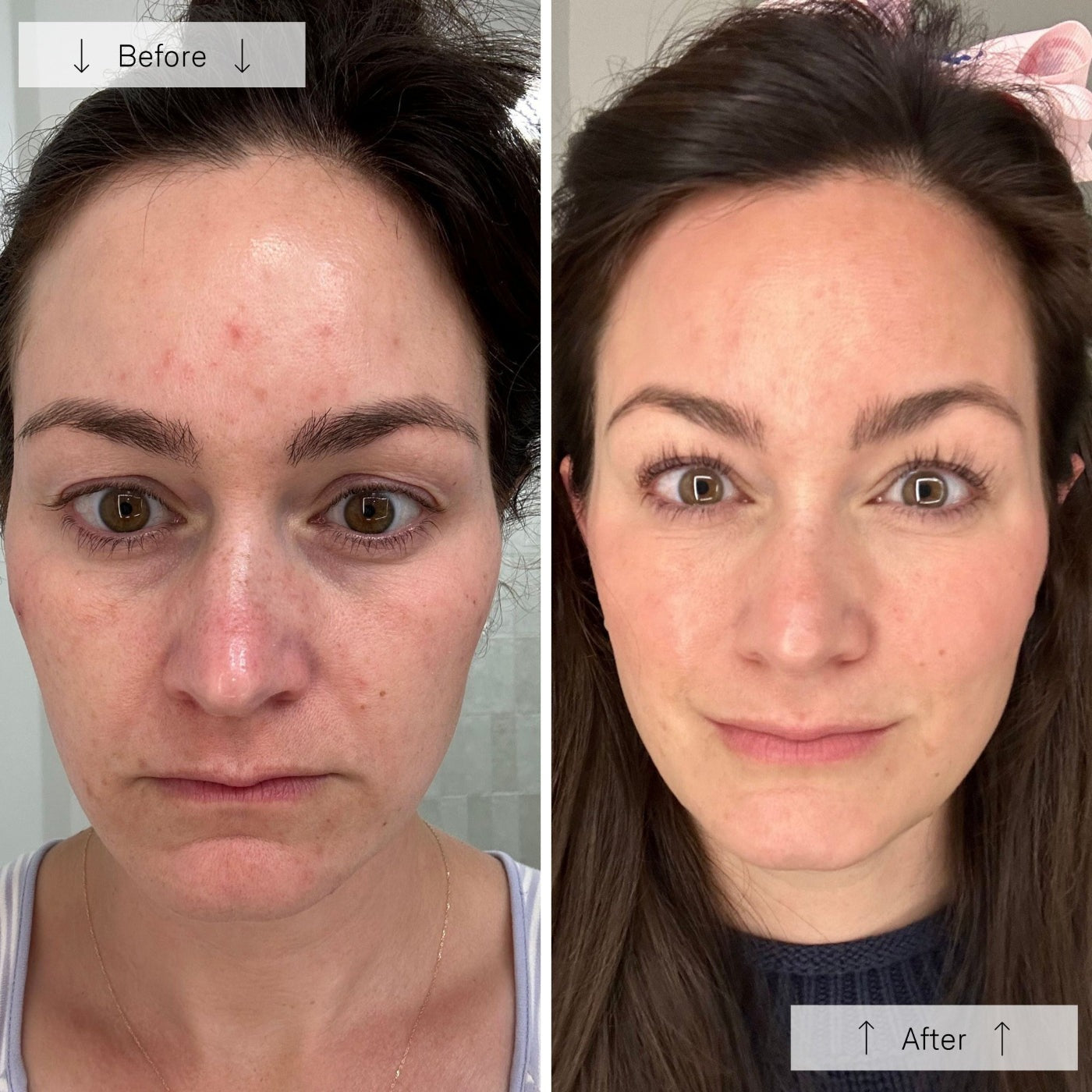 Before and after comparison of a woman's face with visible skin improvement.