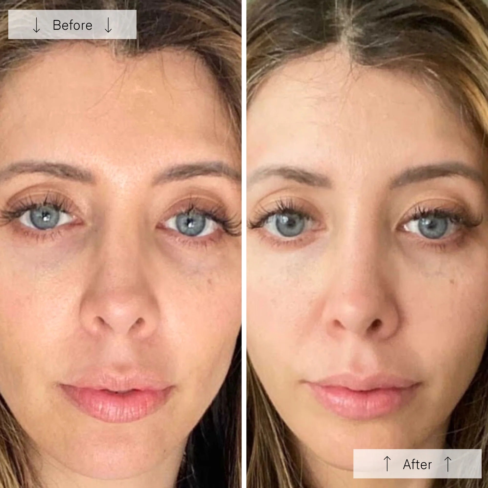 Before and after comparison of a woman's face with visible skin changes.