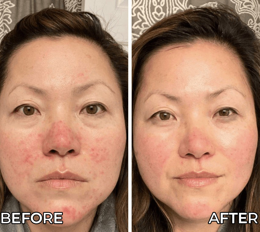 Before and after comparison of a woman's face with visible skin improvement.