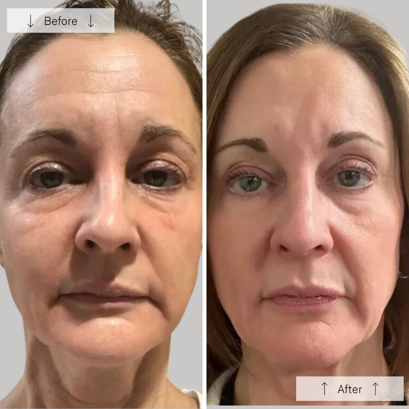 Before and after comparison of a woman's face with visible skin texture differences.